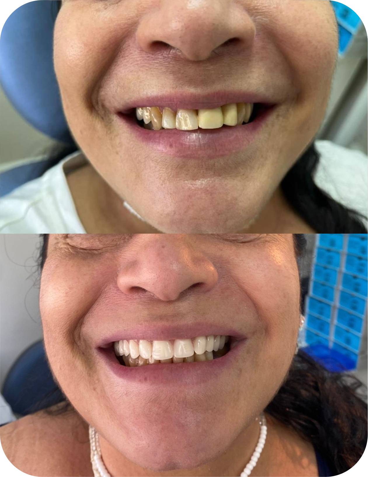 antes depois
